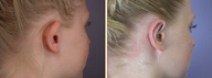 Ear Surgery
