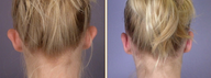 Ear Surgery