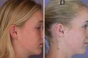 Ear Surgery