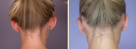 Ear Surgery 