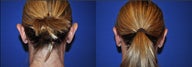 Otoplasty