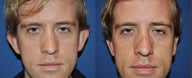 Otoplasty