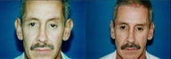 Otoplasty