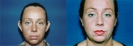 Otoplasty