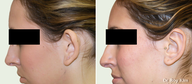 Otoplasty-Ear Surgery