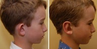 Otoplasty