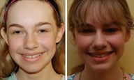 Otoplasty ear augmentation