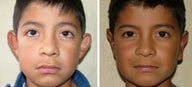 Otoplasty ear augmentation
