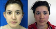 Otoplasty