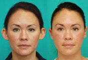 Otoplasty