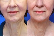 Exilis Skin Tightening