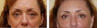 Blepharoplasty