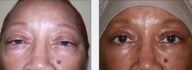Blepharoplasty