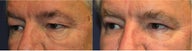 Eye Bags Treatment