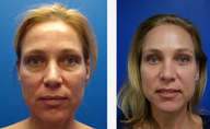 Blepharoplasty