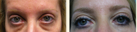 Filling Tear Troughs 