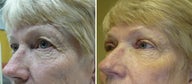Cosmetic eyelid surgery