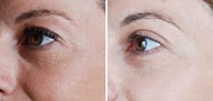 Cosmetic eyelid surgery