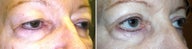 Cosmetic eyelid surgery