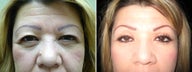 Cosmetic eyelid surgery