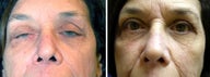 Ptosis (Droopy Eyelid)
