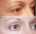 Eyelid surgery