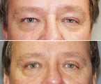 Eyelid surgery