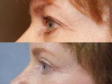 Eyelid Surgery