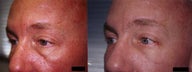 Lower Eyelid Dark Circles Blepharoplasty