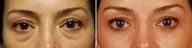 Cosmetic Eyelid Surgery