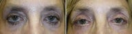 Revisional Eyelid Surgery