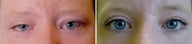 Revisional ptosis repair of left upper eyelid