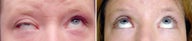 Revisional ptosis repair of left upper eyelid