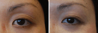 Eyelid Surgery