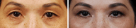 Eyelid Surgery