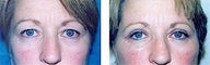 Eyelid surgery