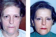 Eyelid surgery