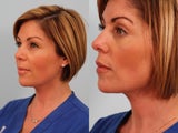 Eyelid Surgery
