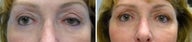 Left upper eyelid ptosis repair