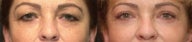Upper Eyelid Blepharoplasty