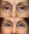 Lower Eyelid Blepharoplasty