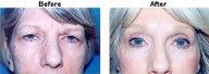 Eyelid surgery