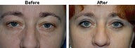 Eyelid Surgery