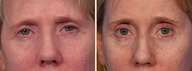 Eyelid Surgery