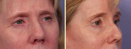 Eyelid Surgery