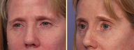 Eyelid Surgery