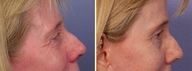 Eyelid Surgery