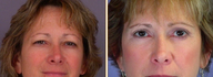 Eyelid Surgery