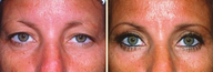 Eyelid Surgery