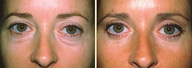 Eyelid Surgery